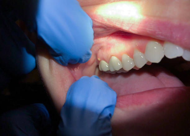 Best Urgent Tooth Repair  in Chesilhurst, NJ